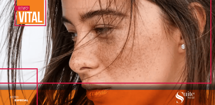 melasma melasma
